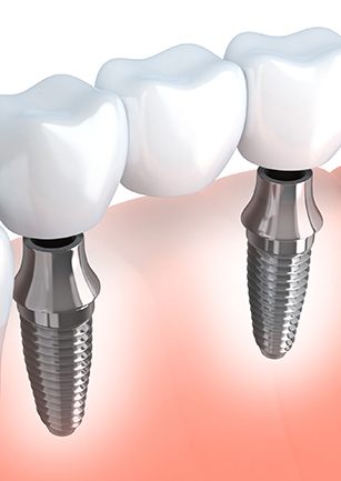 Animation of an implant supported fixed bridge