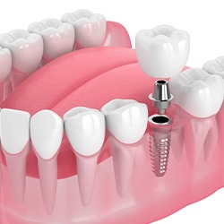 Illustration of a single dental implant