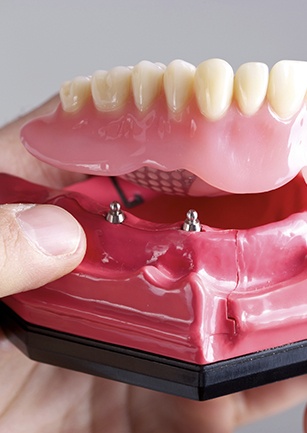 Implant retained denture model