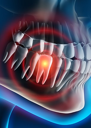 Aniamtion of tooth that needs to removed