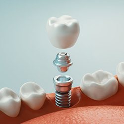 a 3D illustration of a dental implant and crown