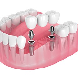 Illustration of an implant bridge