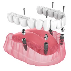 Illustration of an implant denture