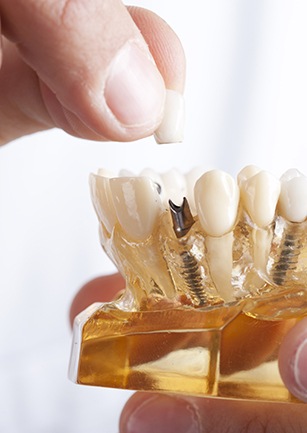 Model smile with implant dental crown