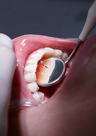 Closeup of teeth during dental exam