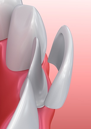 Animation of veneer placement