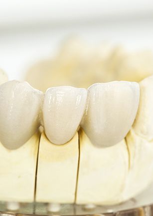 Closeup of dental model