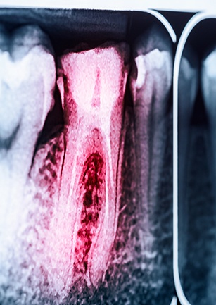 X-ray of root canal treated tooth