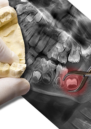 X-ray and dental model of tooth to be removed