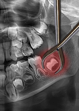 Animation of x-ray with tooth to be removed