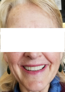 after smile makeover